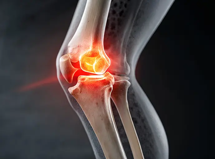 knee joint with pain and inflammation