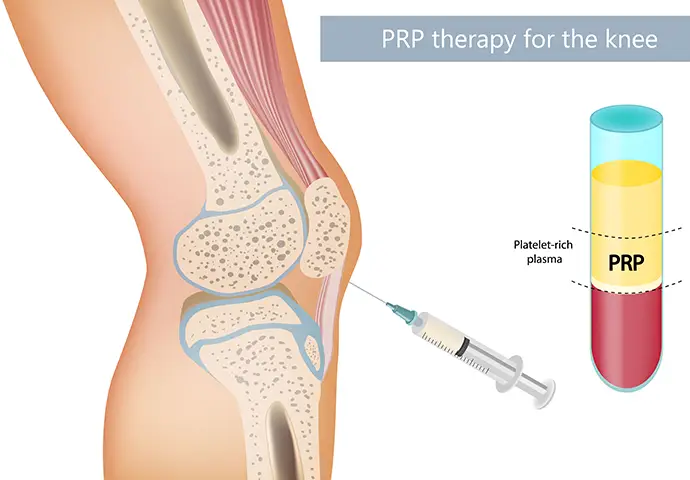Platelet Rich Plasma Treatment for Knee Osteoarthritis